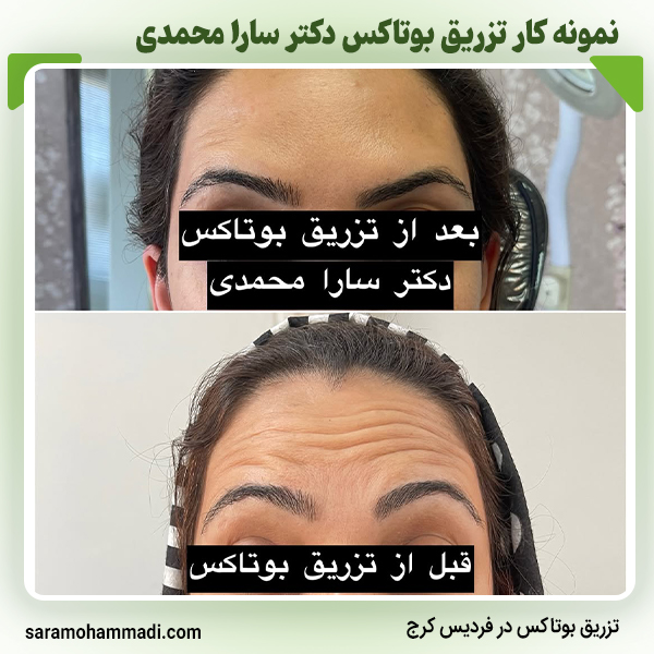 نمونه کار بوتاکس1