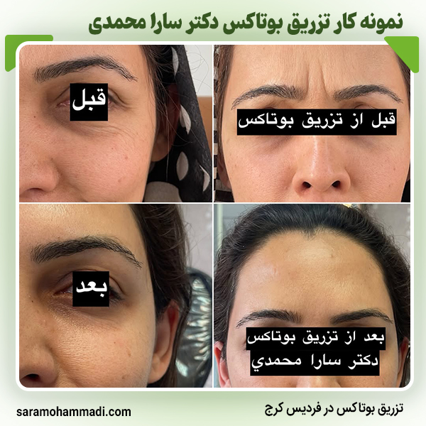 نمونه کار بوتاکس2