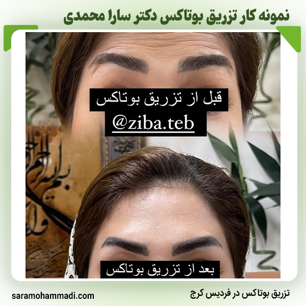 نمونه کار بوتاکس3