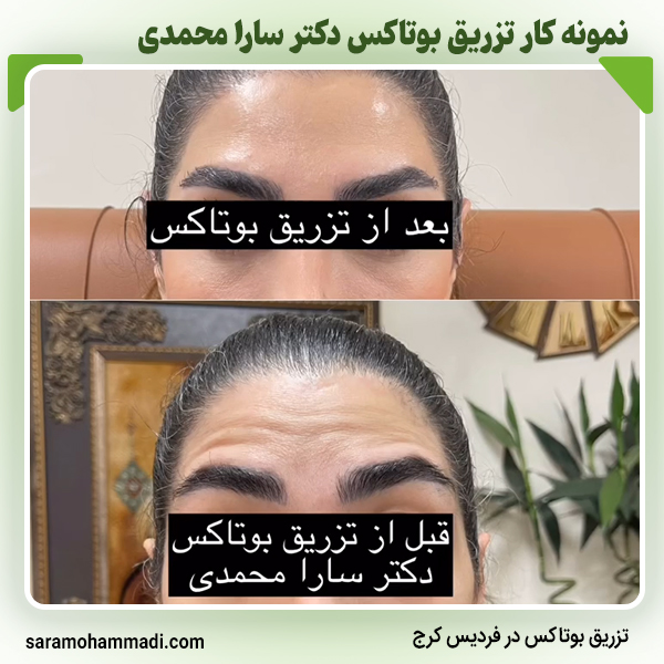 نمونه کار بوتاکس4