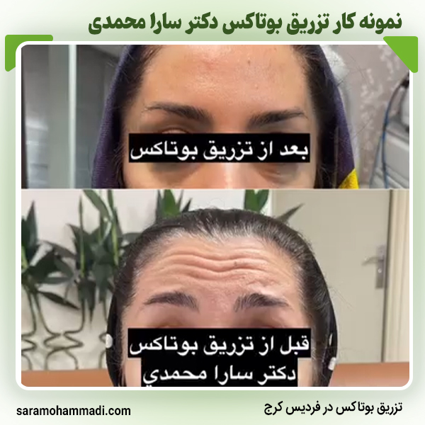 نمونه کار بوتاکس5