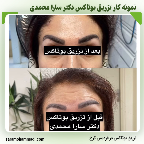 نمونه کار بوتاکس6