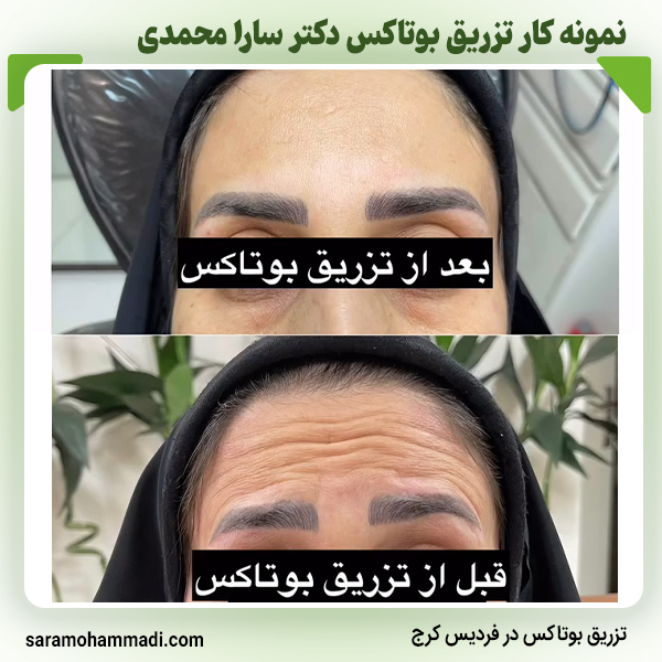 نمونه کار بوتاکس7