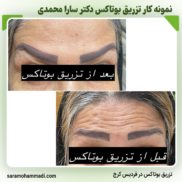 نمونه کار بوتاکس8