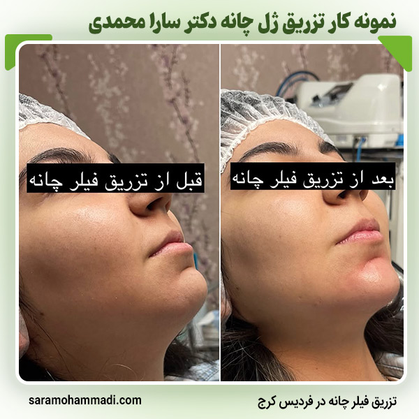 خدمات تزریق ژل چانه