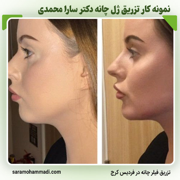 مراحل انجام تزریق ژل چانه