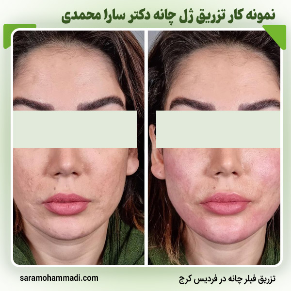 ماندگاری تزریق ژل چانه