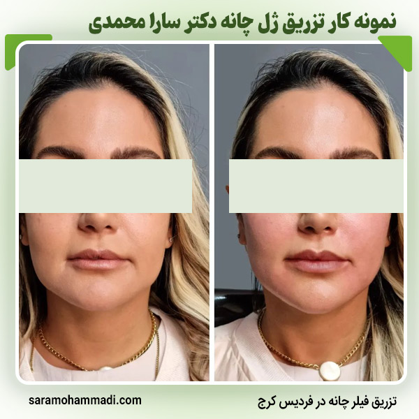تزریق ژل چانه در کرج با بهترین ژل و فیلر