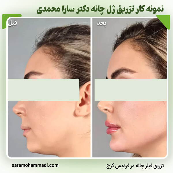 تزریق فیلر و ژل چانه در فردیس