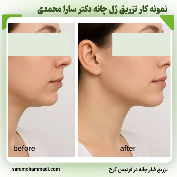 مراقبت‌های بعد از تزریق ژل چانه