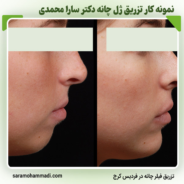 قیمت تزریق ژل چانه در کرج
