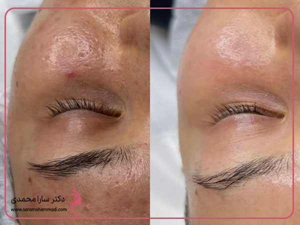 انجام خدمات فیشیال و پاکسازی پوست