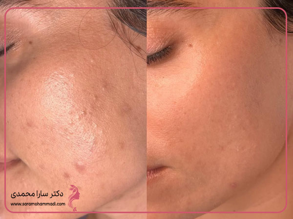 قبل و بعد از فیشیال پوست در مطب دکتر سارا محمدی