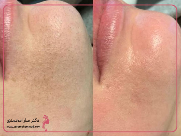 قبل و بعد مراقبت و پاکسازی پوست
