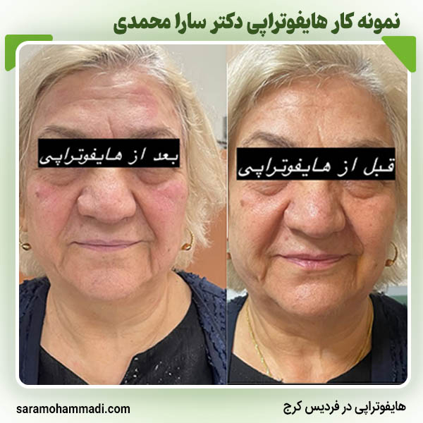 هایفوتراپی در فردیس