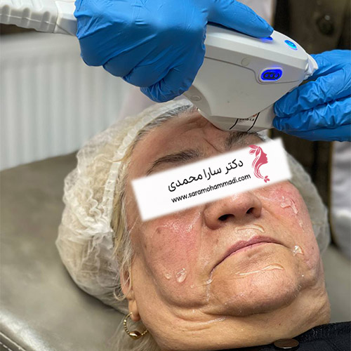 جوانسازی بدون درد با هایفوتراپی