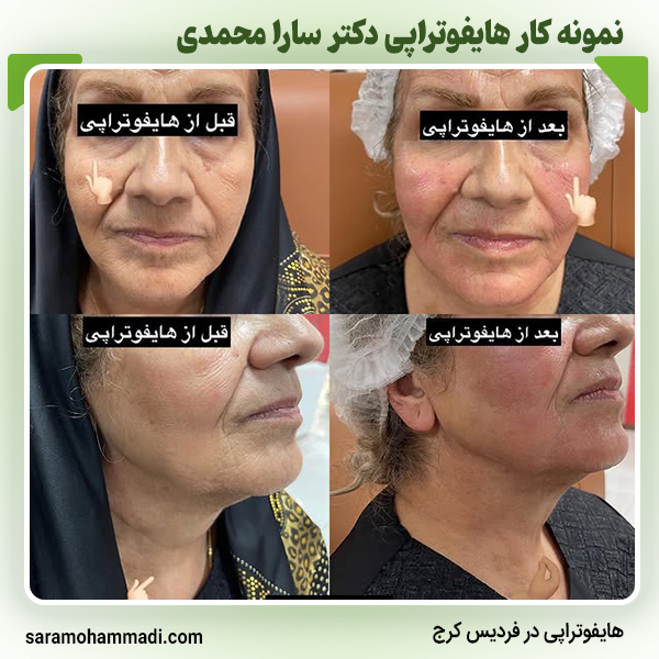 نمونه کار هایفوتراپی در فردیس