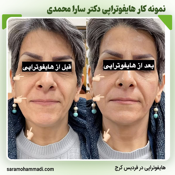 نمونه کار هایفوتراپی