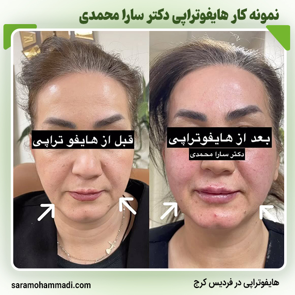 انجام هایفوتراپی برای زیباجو در فردیس
