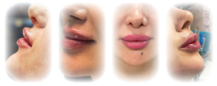 نمونه کار تزریق ژل لب در فردیس