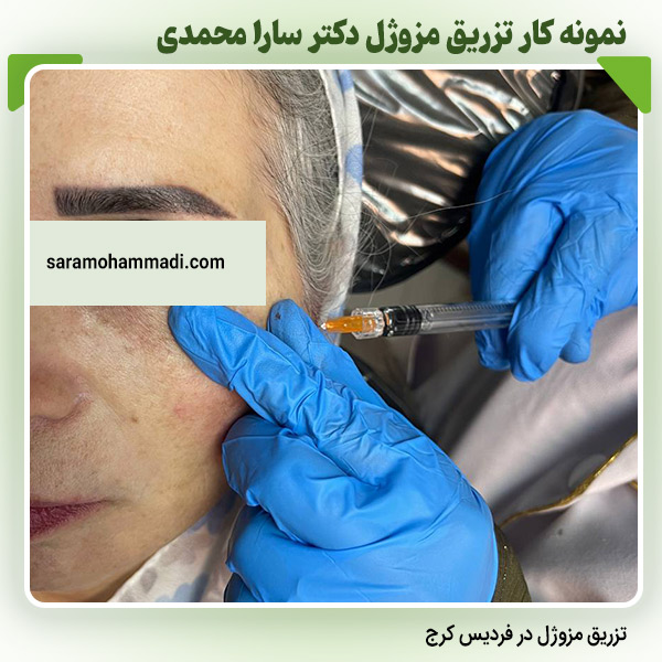 خدمات تزریق مزوژل و کاربردهای آن