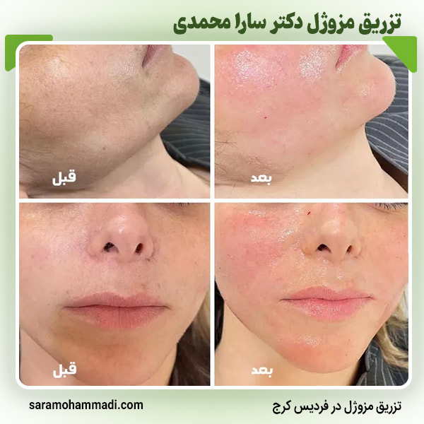 بهترین مرکز تزریق مزوژل در کرج