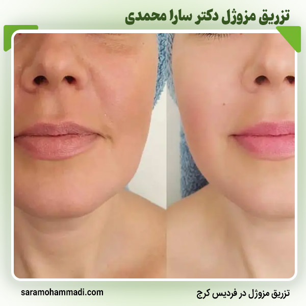 مراقبت‌های قبل و بعد از تزریق مزوژل
