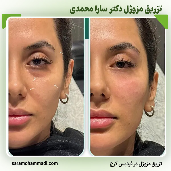 ماندگاری تزریق مزوژل