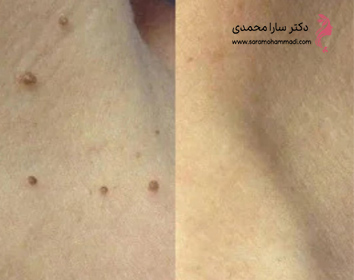 نمونه قبل و بعد برداشتن خال