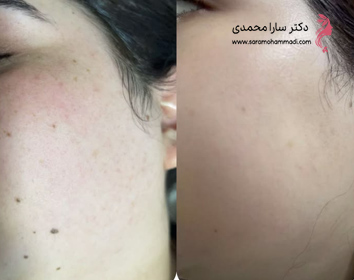نمونه قبل و بعد برداشتن خال صورت