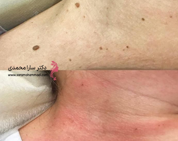 نمونه درمان و برداشتن خال