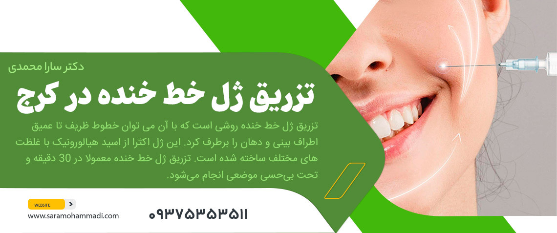 تزریق ژل خط خنده در کرج