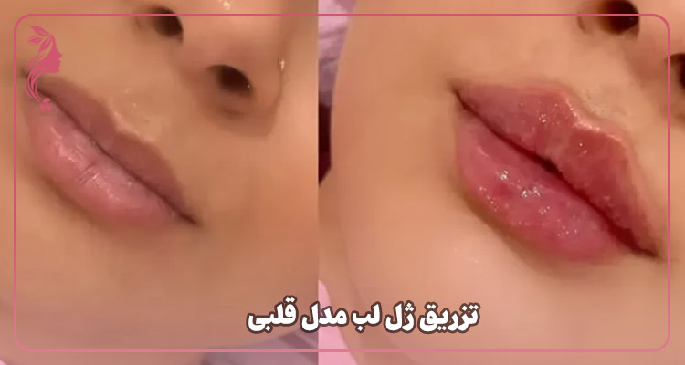 تزریق ژل لب مدل قلبی