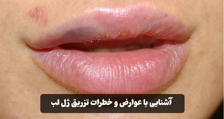 عوارض و خطرات تزریق ژل لب