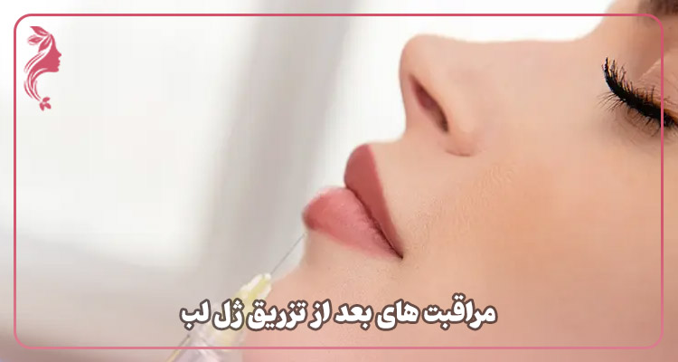 مراقبت های بعد از تزریق ژل لب