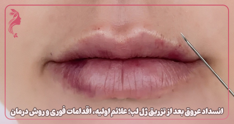 انسداد عروق بعد از تزریق ژل لب