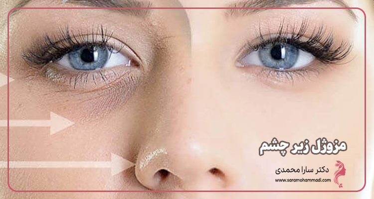 مزوژل زیر چشم