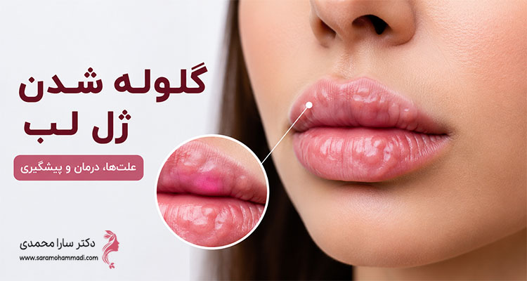 گلوله شدن ژل لب