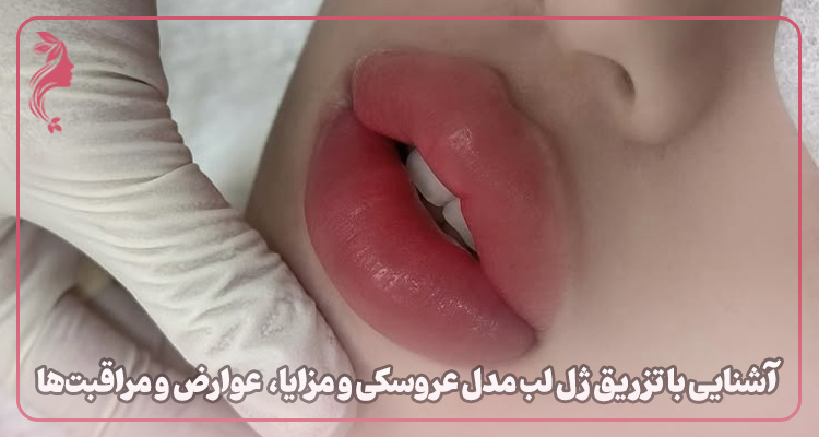 تزریق ژل لب مدل عروسکی