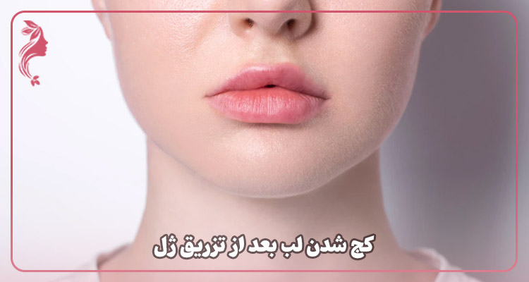 کج شدن لب بعد از تزریق ژل
