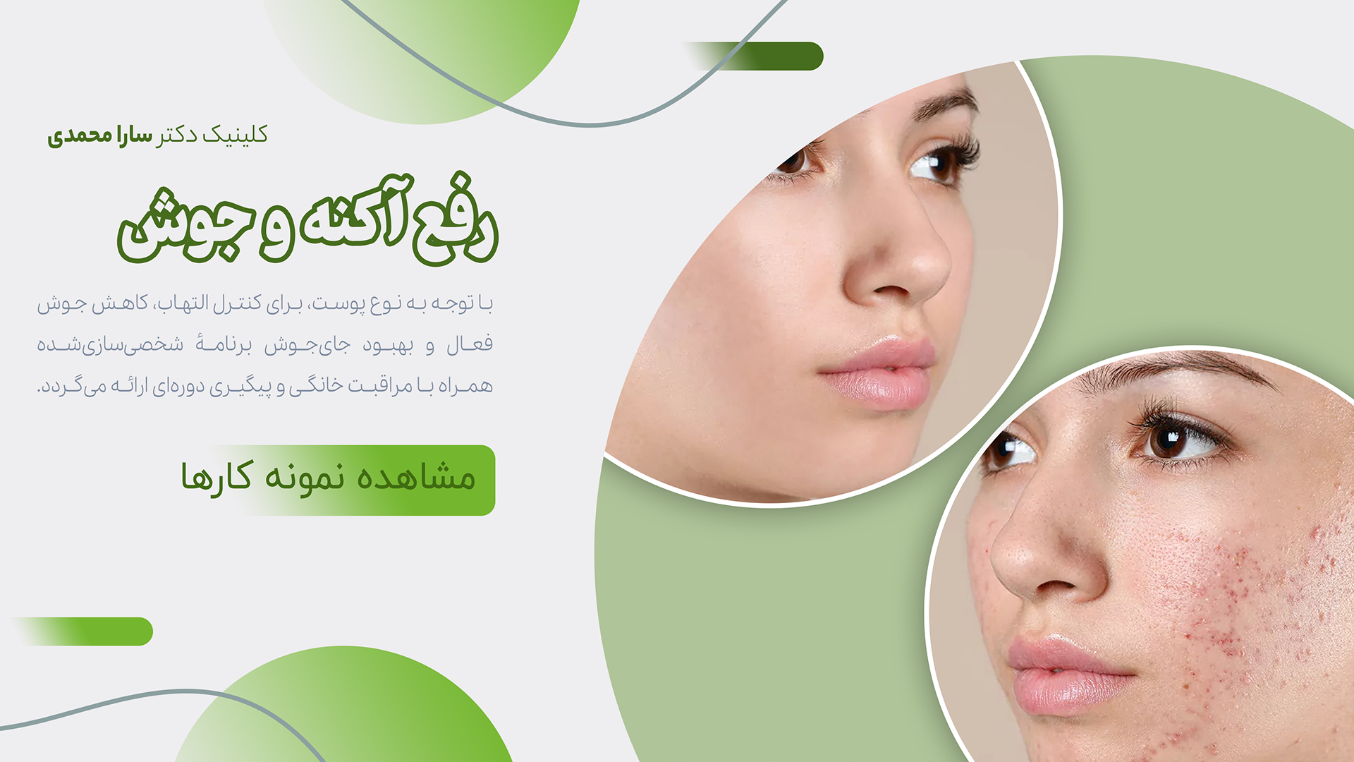 رفع جوش و آکنه